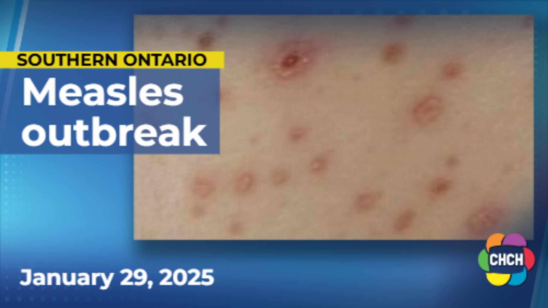 2 more cases of measles in Haldimand-Norfolk, Jan. 21 exposure date