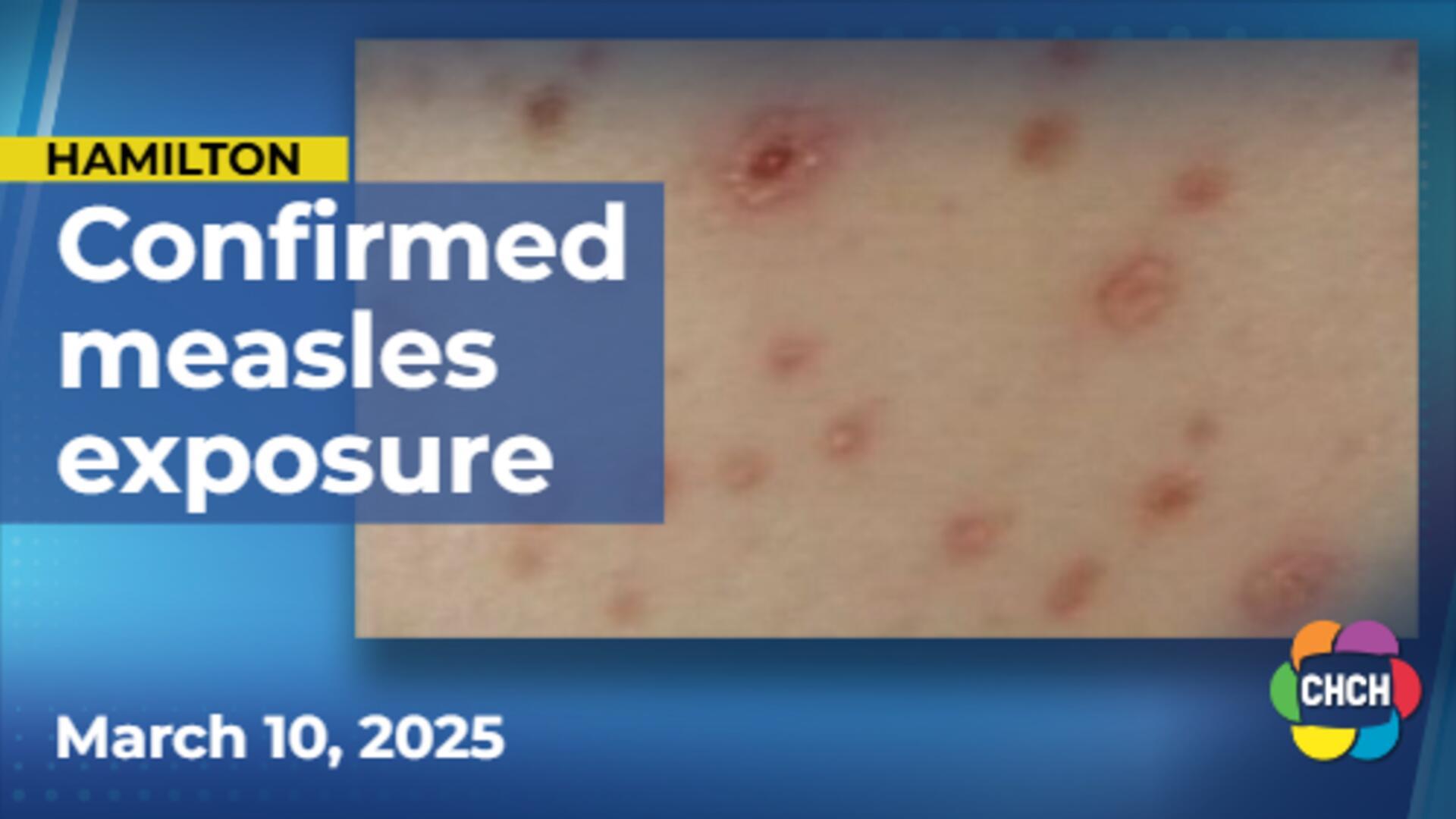Hamilton Public Health investigate confirmed case of measles