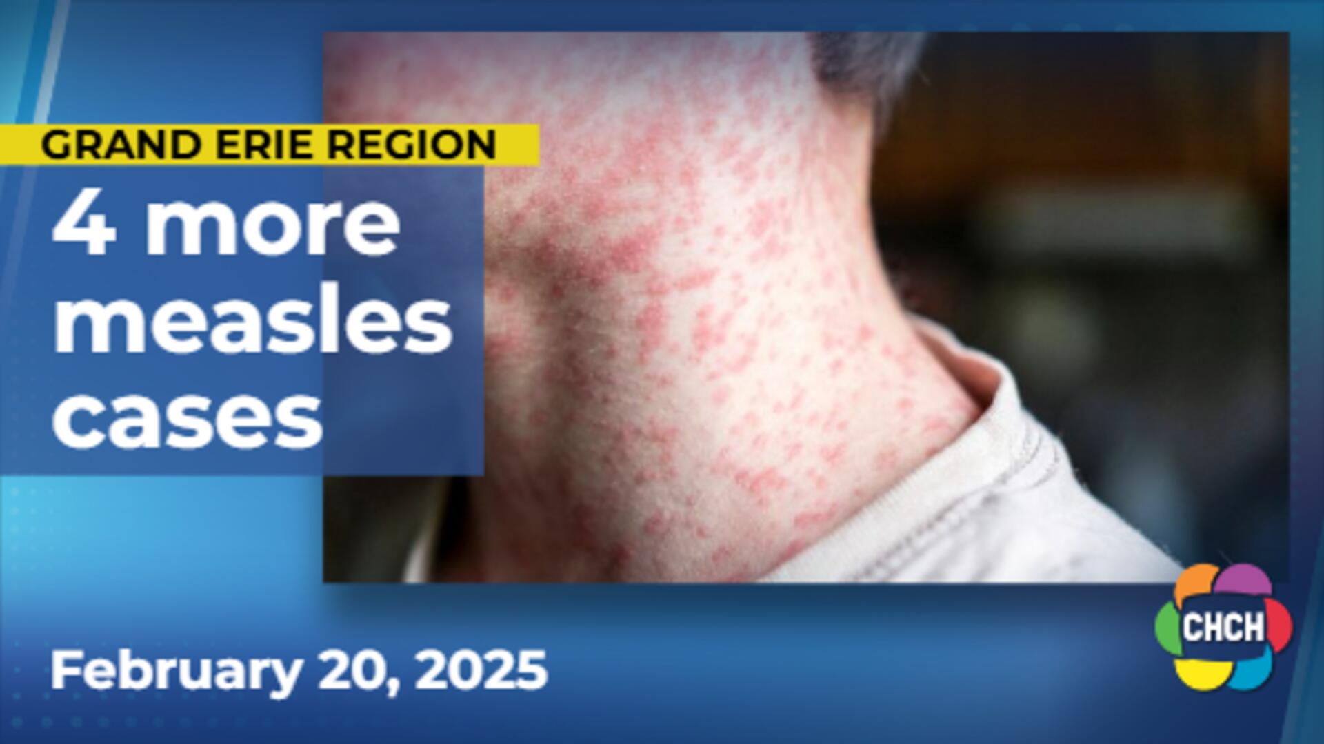 Grand Erie Public Health confirms 4 more measles cases