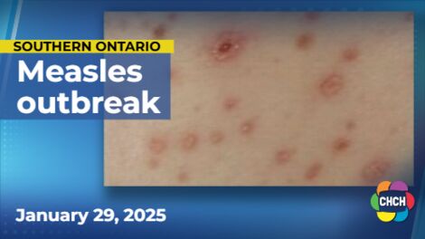 2 more cases of measles in Haldimand-Norfolk, Jan. 21 exposure date