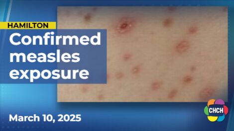 Hamilton Public Health investigate confirmed case of measles